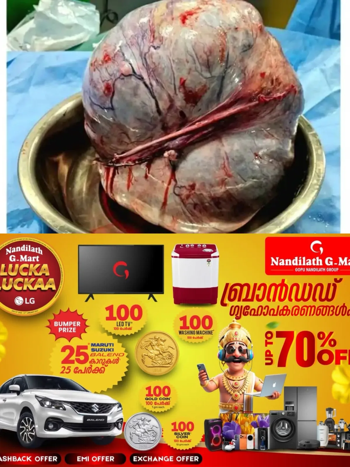 തൊടുപുഴയിൽ 80കാരിയുടെ വയറ്റില്നിന്നും 16.8 കിലോയുള്ള കൂറ്റൻ അണ്ഡാശയമുഴ നീക്കം ചെയ്തു
