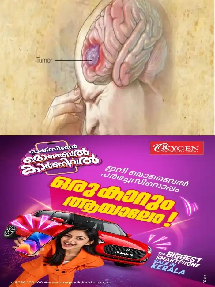 ഇടയ്ക്കിടെ ഉണ്ടാകുന്ന തലവേദനയെ നിസാരമായി കാണരുത്;ബ്രെയിന് ട്യൂമറിന്റെ ആദ്യകാല ലക്ഷണങ്ങള് ഇതൊക്കെയാണ്