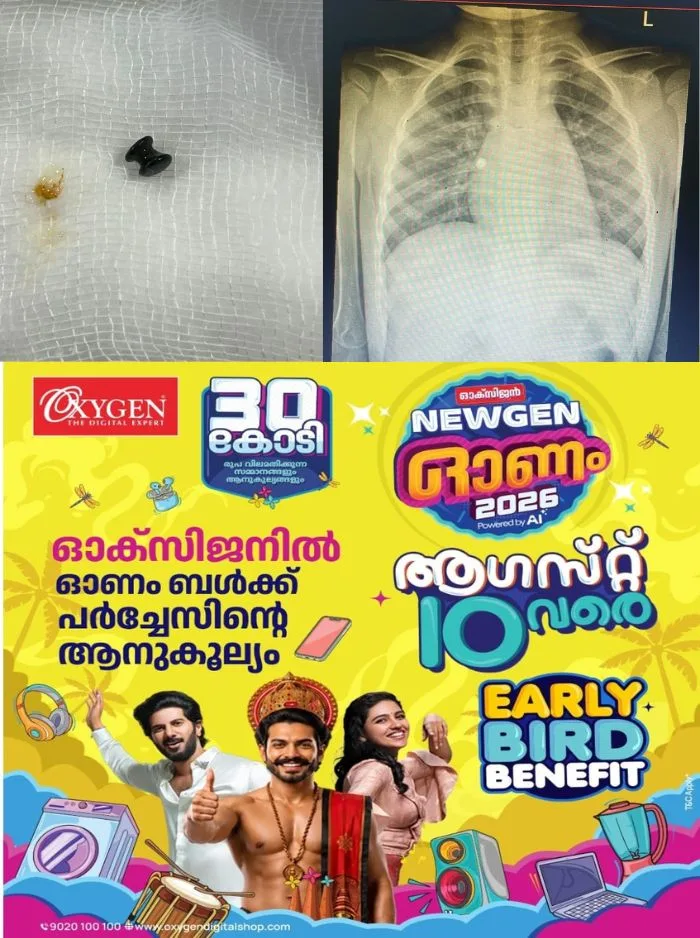 അബദ്ധത്തിൽ കളിപ്പാട്ടത്തിലെ മുത്ത് കുഞ്ഞിന്റെ ശ്വാസകോശത്തിൽ കുടുങ്ങി; രക്ഷകരായി വിപിഎസ് ലേക്ഷോറിലെ ഡോക്ടർമാർ, കുഞ്ഞിന്റെ ജീവൻ രക്ഷിച്ചത് അടിയന്തിര ബ്രോങ്കോസ്കോപ്പിയിലൂടെ