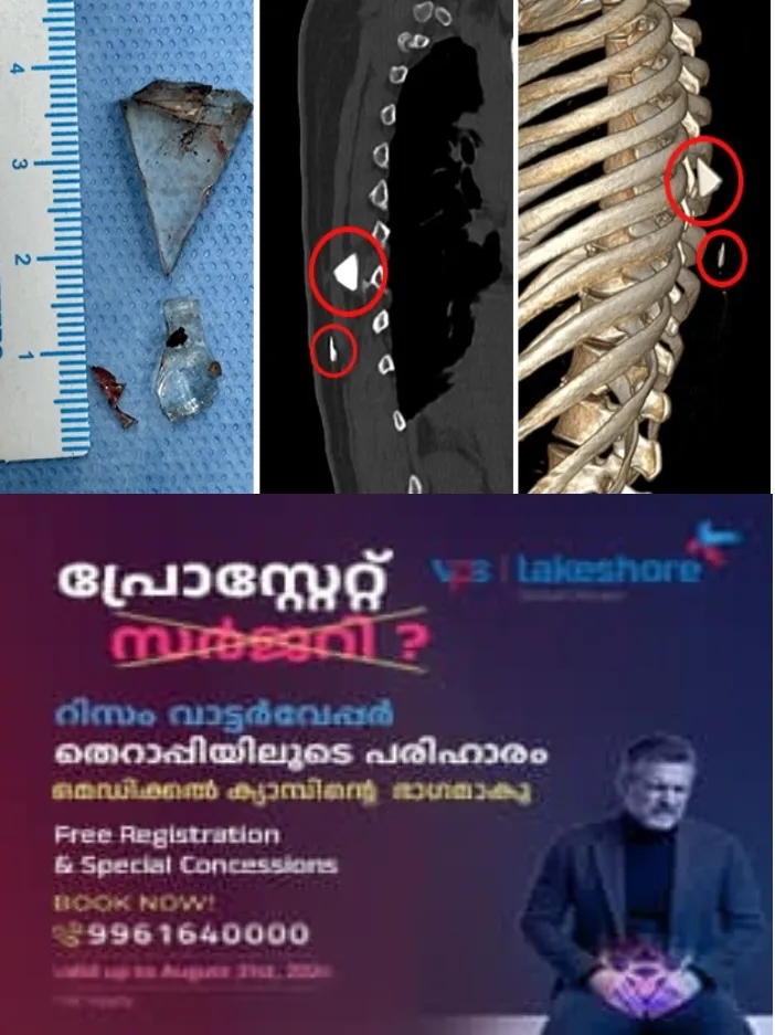 വേദന നിറഞ്ഞ 12 വർഷം;കാരണമറിയാതെ ആശുപത്രികളിൽ നിന്ന് ആശുപത്രികളിലേക്ക്; ഒടുവിൽ രക്ഷകരായി വി.പി.എസ് ലേക്ഷോർ ഹോസ്പിറ്റൽ;യുവതിയുടെ നട്ടെല്ലിൽ നിന്ന് ഗ്ലാസ് കഷ്ണങ്ങൾ നീക്കം ചെയ്ത് വി.പി.എസ് ലേക്ഷോറിലെ വിദഗ്ധ സംഘം
