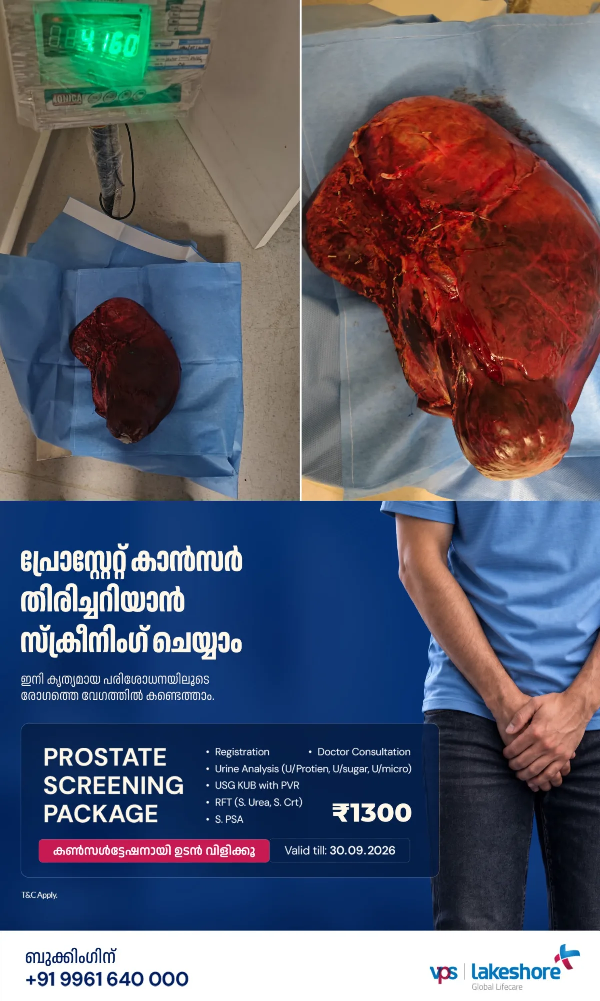 വയറിലെ അസ്വഭാവിക തടിപ്പ് പരിശോധിച്ചപ്പോൾ കണ്ടെത്തിയത് കരളിൽ നാല് കിലോഗ്രാം ഭാരമുള്ള ട്യൂമർ; സങ്കീർണ ശസ്ത്രക്രിയയിലൂടെ വിജയകരമായി നീക്കം ചെയ്ത് വി.പി.എസ് ലേക്ഷോറിലെ വിദഗ്ധ സംഘം