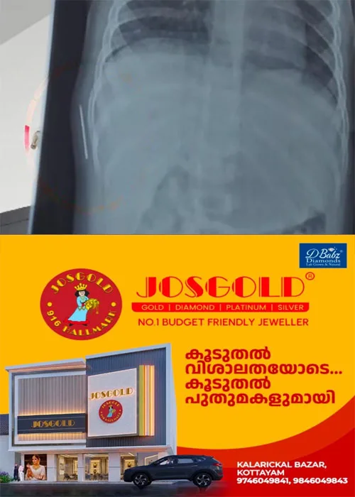 ഒരു വയസുള്ള കുഞ്ഞിന്റെ ശരീരത്തില്‍ സൂചി; കോട്ടയം മെഡിക്കല്‍ കോളജില്‍ വീണ്ടും  ചികിത്സാ പിഴവ്; കുഞ്ഞ് വേദന സഹിച്ചത് ഒരു വര്‍ഷത്തോളം;ഡെപ്യൂട്ടി സൂപ്രണ്ടിന്റെ നേതൃത്വത്തില്‍ അന്വേഷണം ആരംഭിച്ചു 