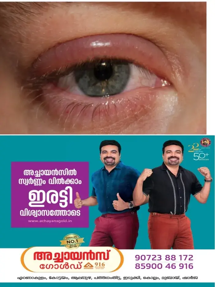 കണ്പോളയില് നിന്നും വേദന;ഇടയ്ക്കിടെ കണ്കുരു വരാറുണ്ടോ? ഈ കാര്യങ്ങൾ ശ്രദ്ധിച്ചില്ലെങ്കിൽ പണി കിട്ടും