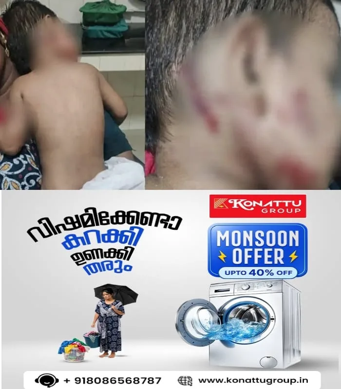 വീണ്ടും തെരുവുനായ ആക്രമണം; കാസര്‍കോട് വീട്ടുറ്റത്ത് കളിച്ചുനിന്ന ഒന്നരവയസുകാരന്റെ മുഖം കടിച്ചുകീറി